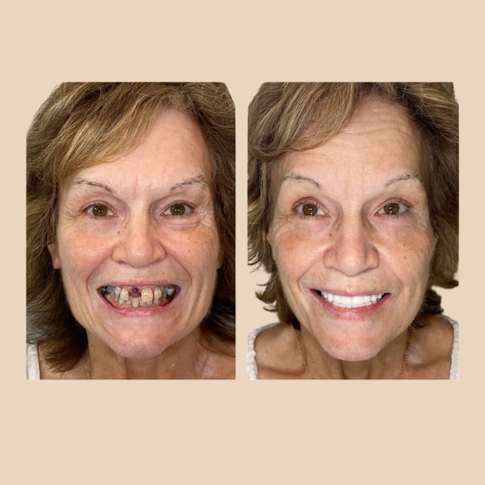 Dentier Premium – ClairSourire™